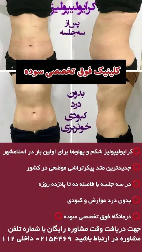 کرایولیپولیز در اسلامشهر واوان- لاغری موضعی محله یار 