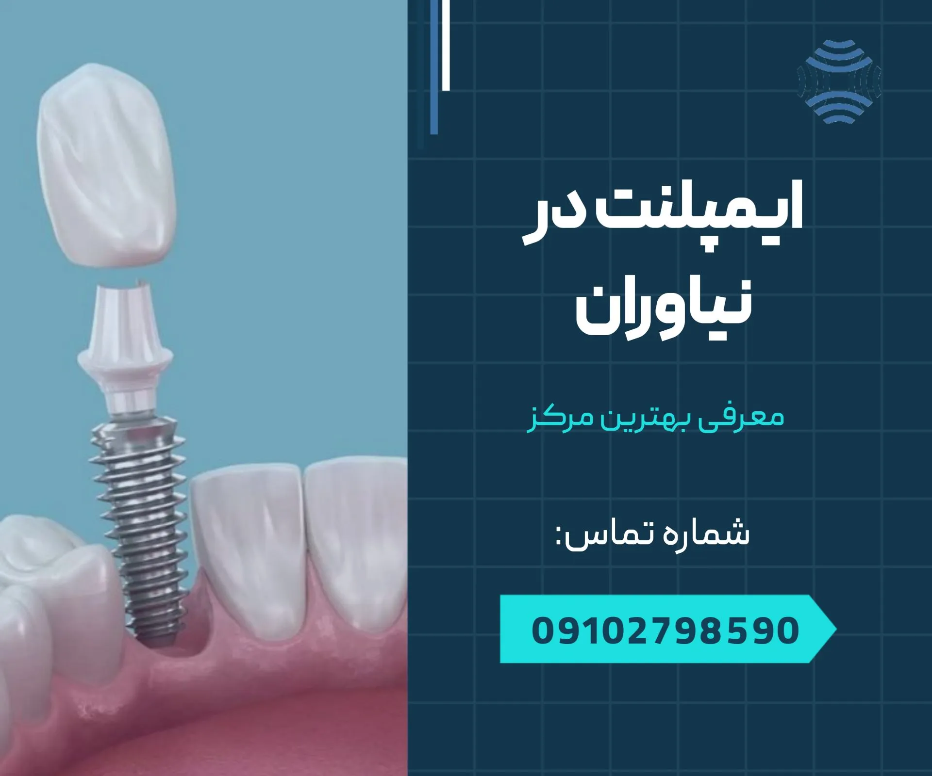 ایمپلنت نیاوران 1 ایمپلنت در نیاوران - محله یار